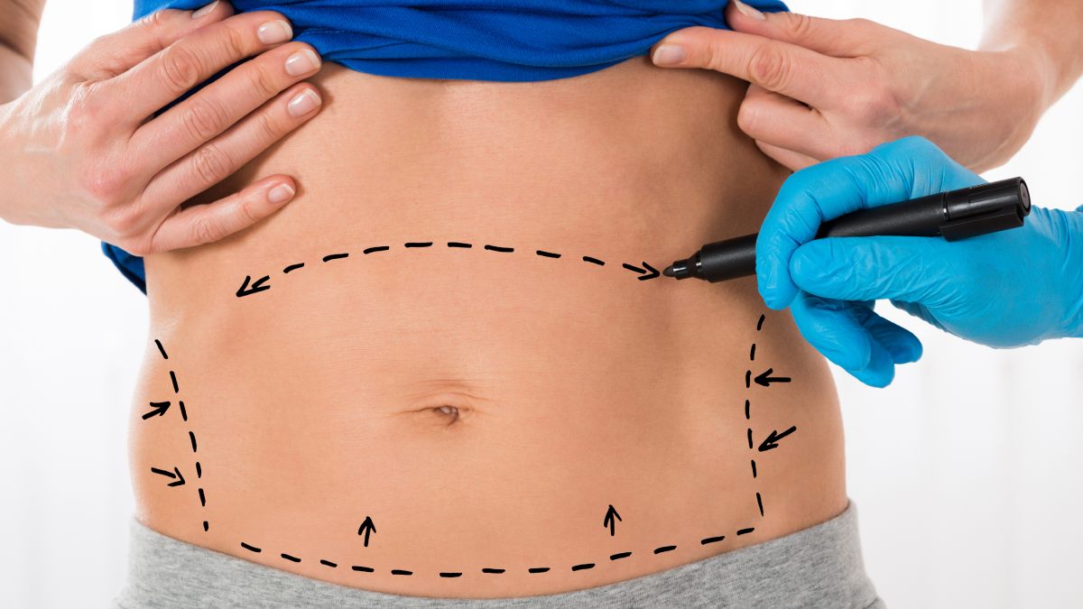 Abdominoplastie ventre plat avec traçage du chirurgien au feutre.