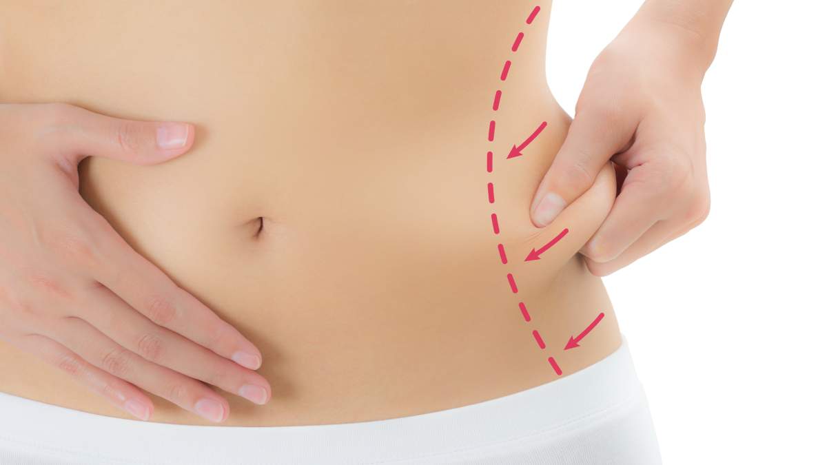 Marquage sur les hanches d'une femme avant une liposuccion.