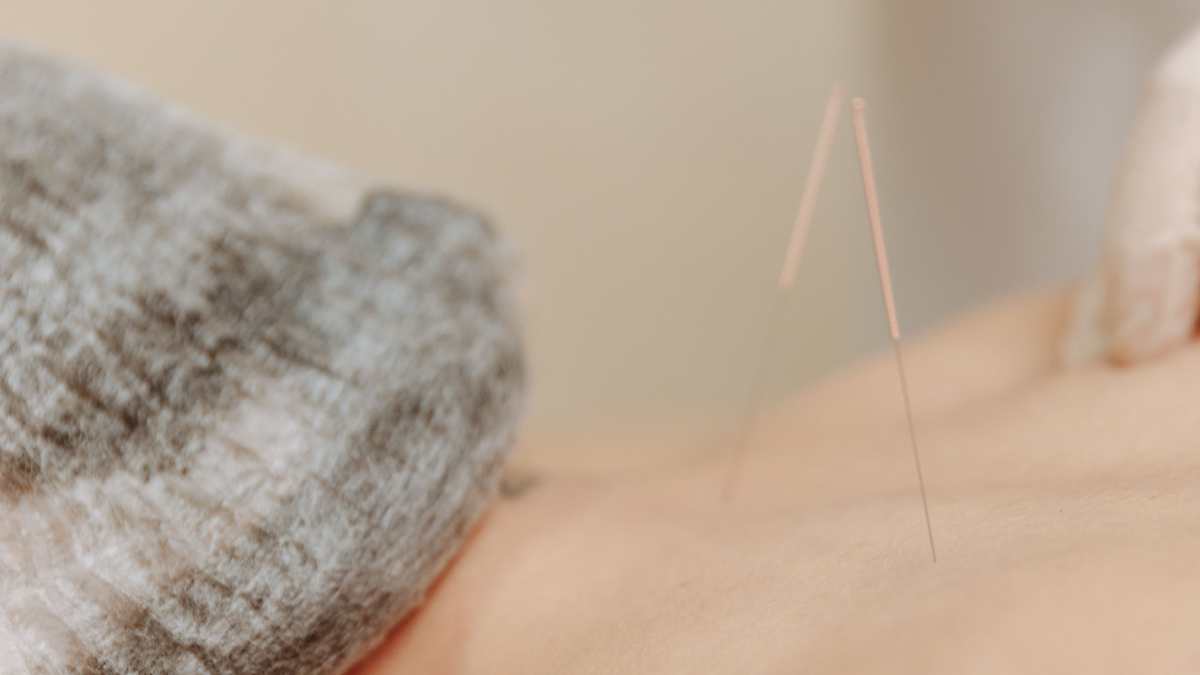 Aiguilles d'acupuncture sur le dos d'une femme.