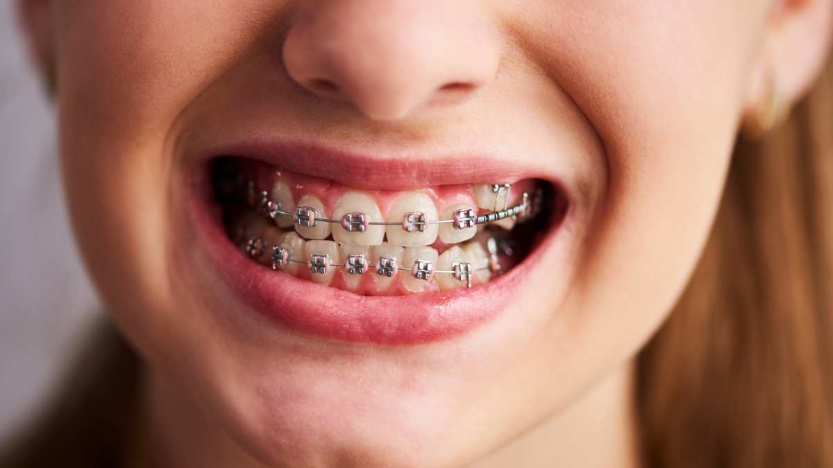 Appareil dentaire sur une jeune fille qui sourit.