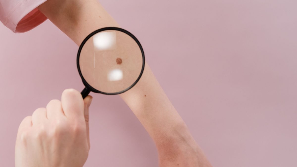 Loupe sur un bras avec un grain de beauté.